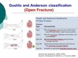 image about تصنيف جوستيلو (Gustilo Classification)