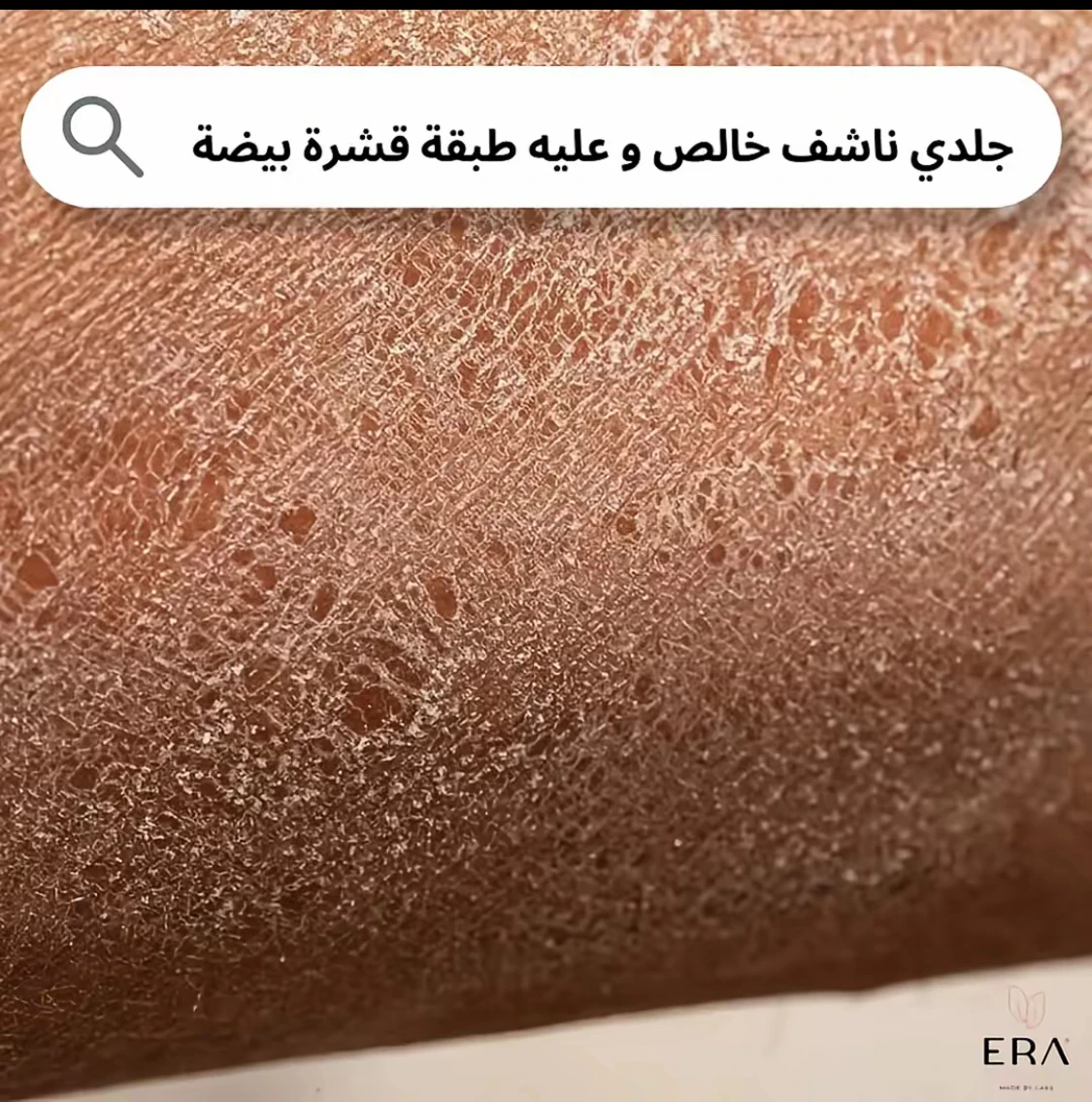 image about التخلص من جفاف الجلد وقشور الجلد في الصيف
