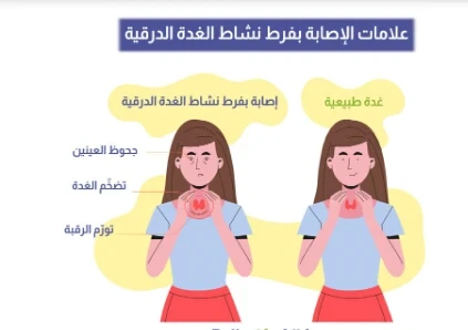 image about نشاط الغده الدراقيه