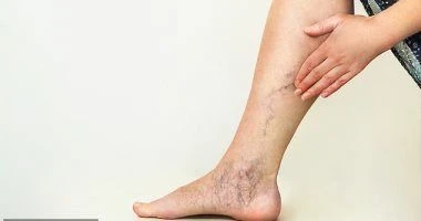 image about أفضل طرق علاج دوالي الساقين بدون جراحة