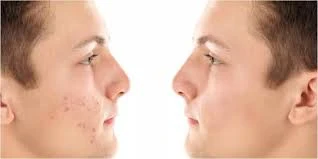 image about علاج آثار الحبوب وعلاج التصبغات بطرق فعّالة لاستعادة صفاء البشرة