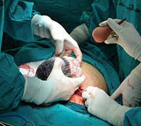 image about الولادة القيصرية اضرار وفوائد