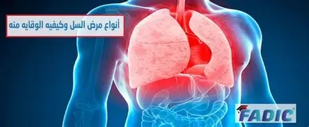 image about السل: الأعراض التفصيلية، طرق الانتقال، والوقاية والعلاج