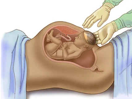 image about أضرار الولاده القيصريه