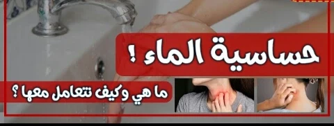 image about حساسيه الماء ( الشري المائي )