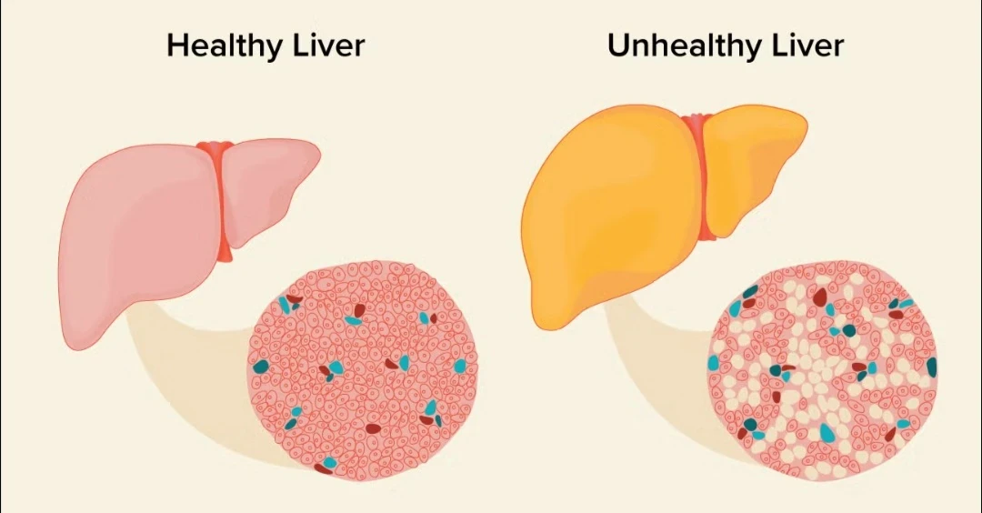 image about Fatty Liver: Causes, Types, Symptoms, Treatment, and the Essential Role of Nutrition