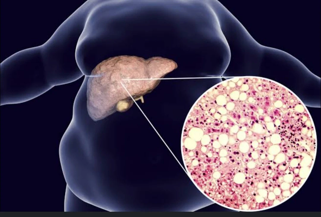 image about Fatty Liver: Causes, Types, Symptoms, Treatment, and the Essential Role of Nutrition