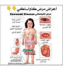 image about مرض كاواساكي... المرض الغامض الذي يهاجم قلوب الأطفال! تعرف على أسبابه وأعراضه وطرق علاجه 