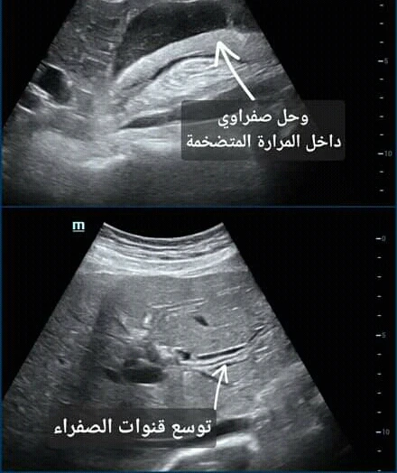 image about المراره الملتهبه المؤلمه