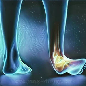 image about التواء الكاحل - الإصابات الرياضية
