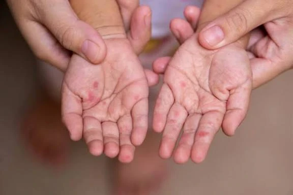 image about فيروس اليد والقدم والفم (HFMD): ما هو؟ وهل يشكل خطرًا؟
