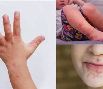 image about فيروس متلازمة اليد والقدم والفم عند الاطفال