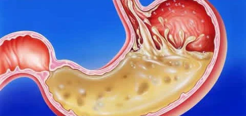 image about عندما تصبح المعده بيئه خطره