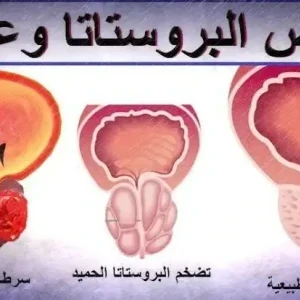 image about ما الأشياء الضارة بالبروستاتا وتسبب تضخمها؟