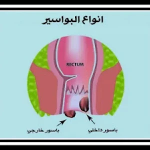 image about علاج البواسير بالليزر بدون جراحة