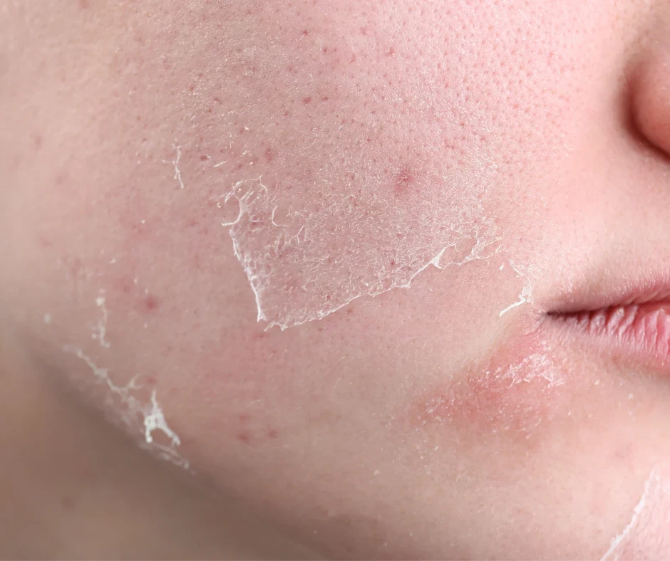 image about سر نضارة البشرة: كل ما تريدين معرفته عن تقشير البشرة بأحماض الفواكه