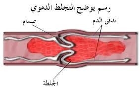 image about الجلطات الدموية: القاتل الصامت وكيفية اكتشافها قبل فوات الأوان