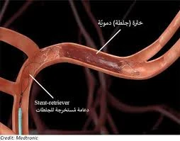 image about الجلطات الدموية: القاتل الصامت وكيفية اكتشافها قبل فوات الأوان