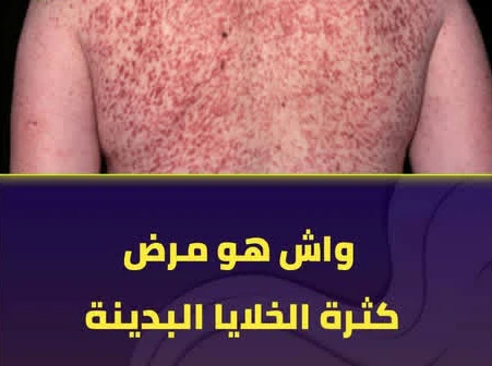 image about عندما يصبح الجلد ناقوس خطر