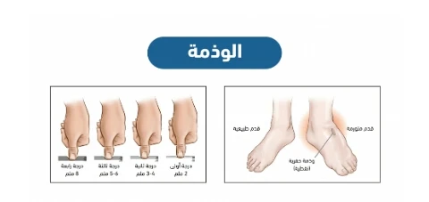 image about التورم الصامت ( الوذمه )