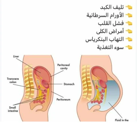 image about التورم الصامت ( الوذمه )