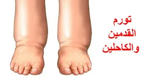 image about التورم الصامت ( الوذمه )