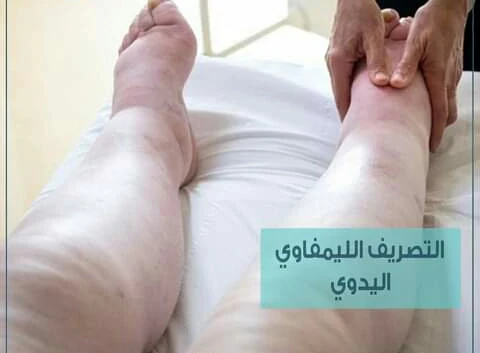 image about التورم الصامت ( الوذمه )