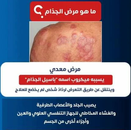 image about الحقيقه وراء مرض الجذام