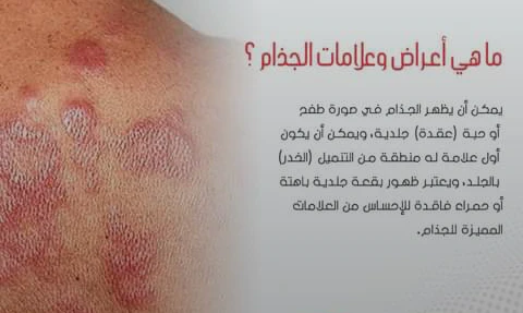image about الحقيقه وراء مرض الجذام