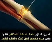 image about علاج العظام فى دقائق ثورة الطب الحيوي المعاصر – ابتكار اللاصق الطبي Bone-02 لعلاج كسور العظام