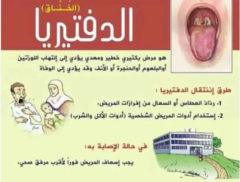 image about الدفتيريا مرض معدي