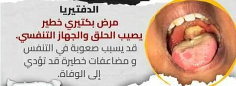 image about الدفتيريا مرض معدي