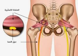 image about ما هو عرق النسا؟