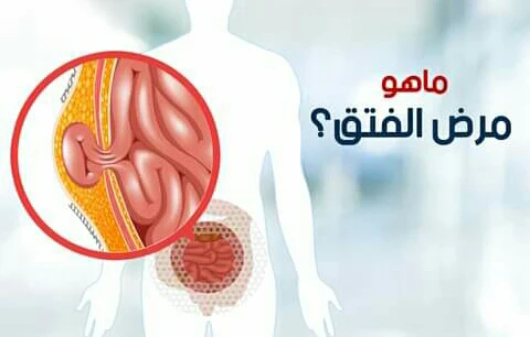 image about أنواع الفتق الشائعه