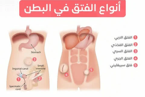 image about أنواع الفتق الشائعه