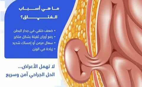 image about أنواع الفتق الشائعه