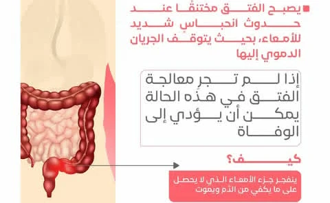 image about أنواع الفتق الشائعه