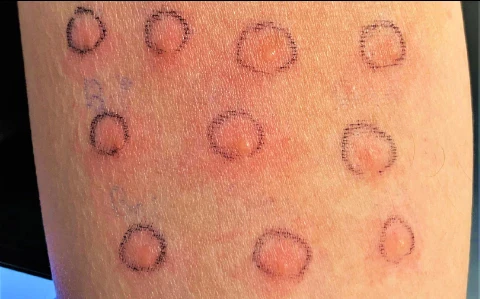 image about مرض الالتهابات النادره