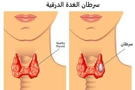image about هل سرطان الغدة الدرقية مميت؟ تعرف على أعراض الغدة الدرقية!