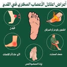 image about ما هو الاعتلال العصبي السكري؟ تلف الأعصاب الذي يجب أن نأخذه على محمل الجد