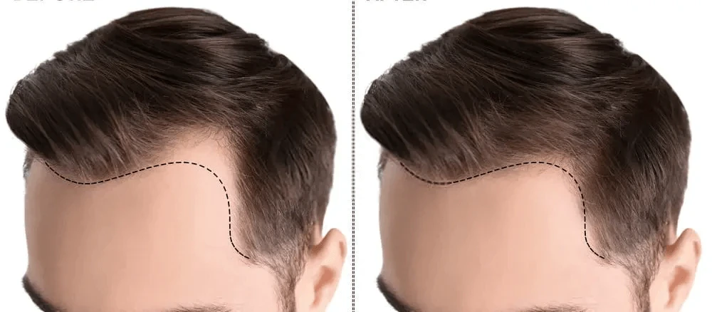 image about زراعة الشعر وكيف تتم هذه العملية؟