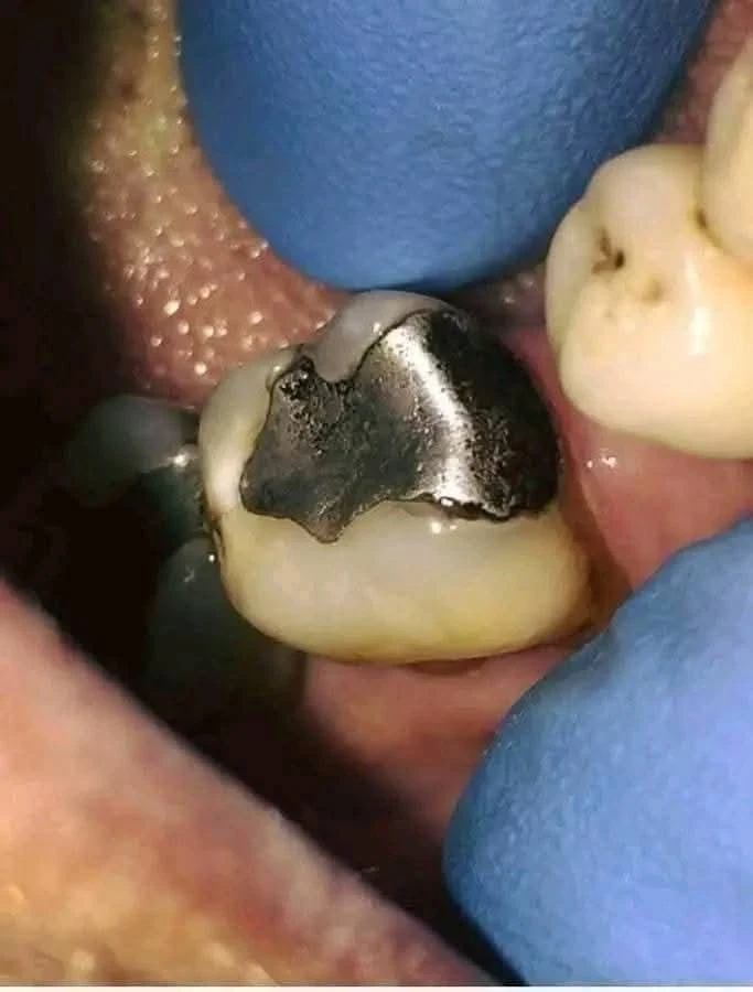 image about الحشوات المعدنية للأسنان: مميزاتها، أضرارها، ونصائح للحفاظ عليها