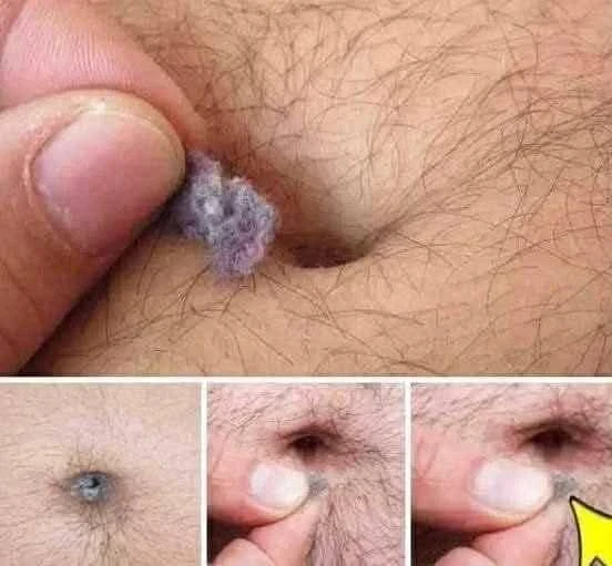 image about وبر السرة: الأسباب الخفية والعلاقة بالالتهابات والسكري والهرمونات