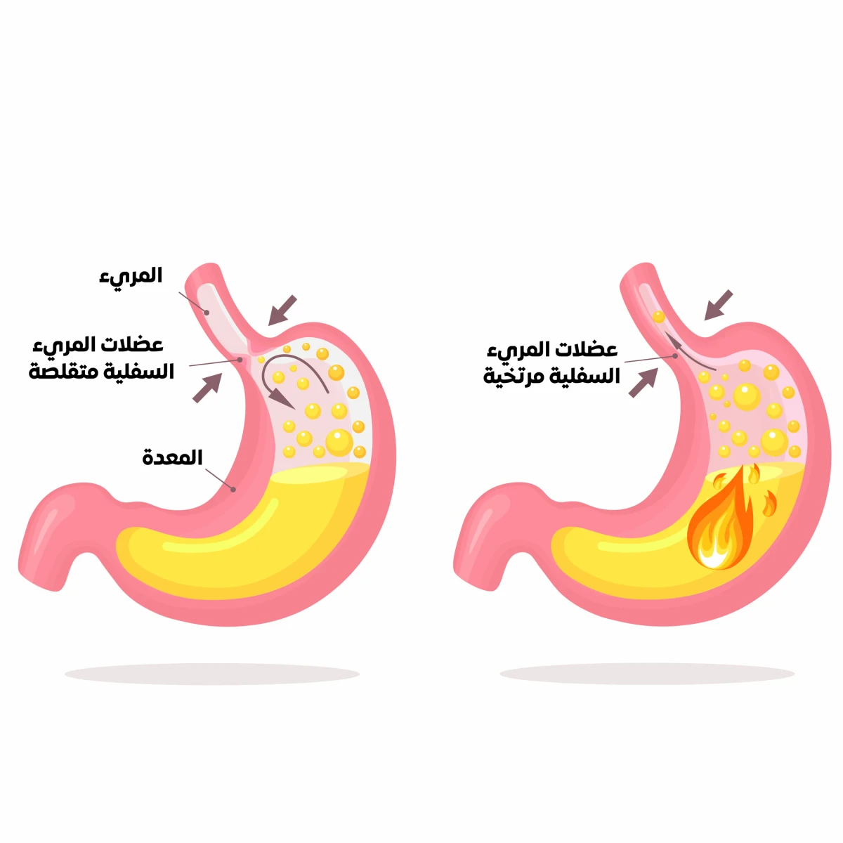 image about ارتجاع المرىء وعلاجه