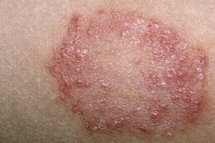 image about الاضطراب الوراثي الذي يسرق القدرة على الشعور بالخوف.