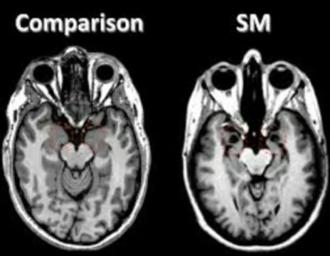 image about الاضطراب الوراثي الذي يسرق القدرة على الشعور بالخوف.