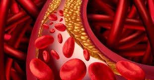 image about فرط شحميات الدم لدى مرضى السكري: الأسباب، الأعراض والعلاج