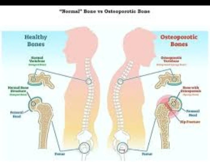 image about هشاشة العظام: المرض الصامت الذي يهدد قوة الجسم