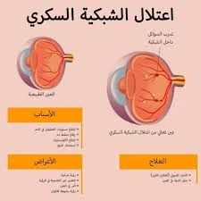 image about اعتلال الشبكية السكري: الأعراض، والأسباب، والعلاج