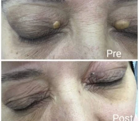 image about ماهي اللويحات الصفراء وماهي اسبابها وطرق علاجها